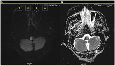 Mechanical thrombectomy treatment for cerebral infarction in circulation after 40 h